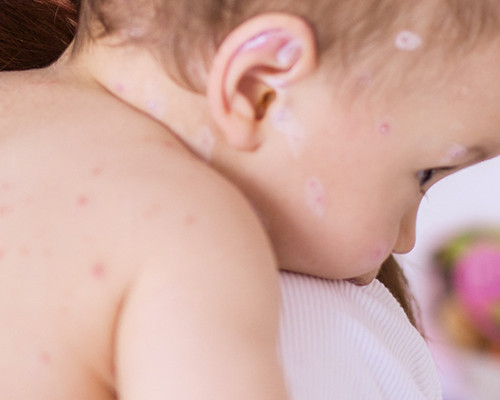 La varicelle chez l'enfant, boutons, démangeaisons et cicatrices